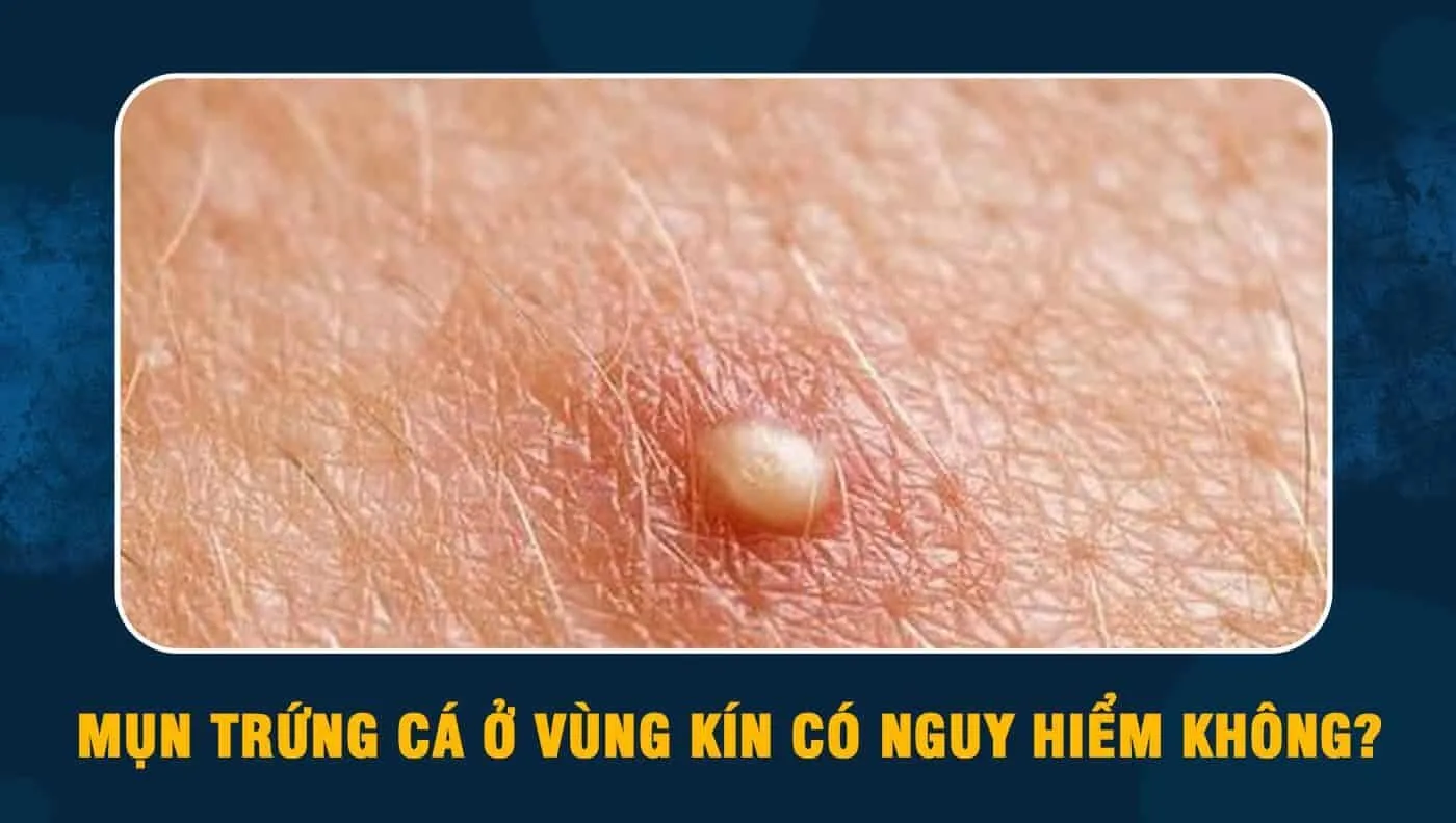 mun-trung-ca-vung-kin-nhan-biet