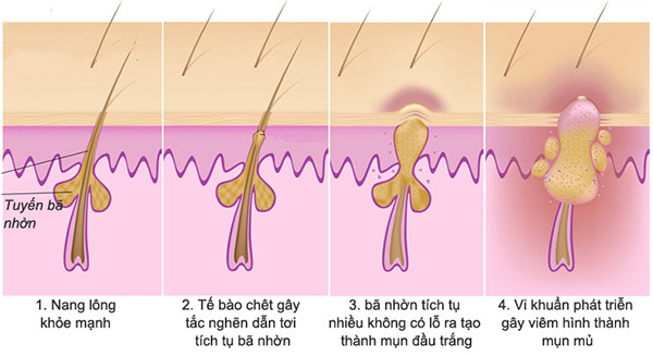 Cơ chế hình thành thâm sau mụn