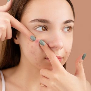 Có Nên Nặn Mụn Hay Không?