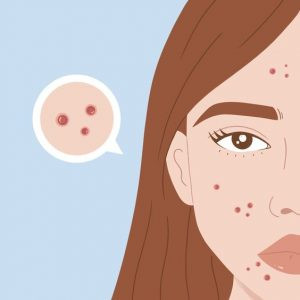 Đặc tính kháng viêm, ngừa mụn của Niacinamide