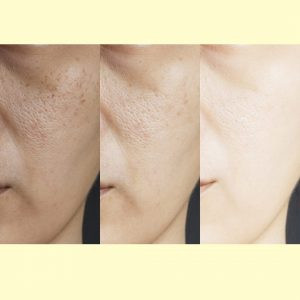 Hạn chế Hydroquinone trong dưỡng da