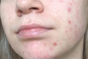 Hiểu về thâm đen sau mụn