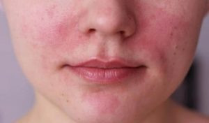 Hỗ trợ điều trị bệnh lý Rosacea