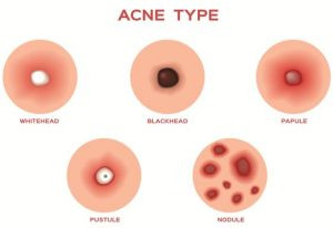 khắc phục vấn đề mụn
