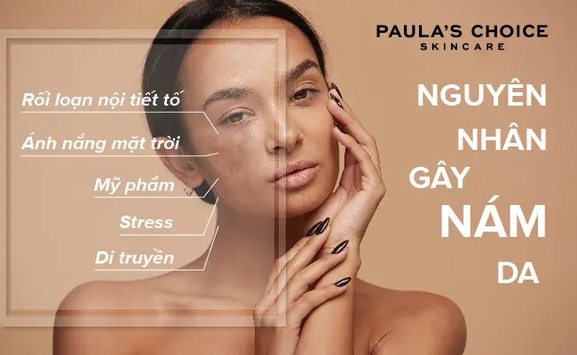 Nguyên nhân gây nám da mặt