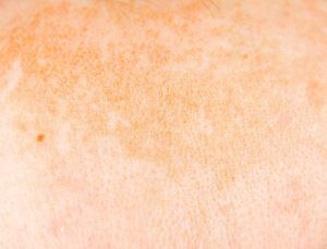 Nguyên nhân gây nám và cách điều trị nám hiệu quả