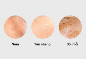 Nhận biết nám da