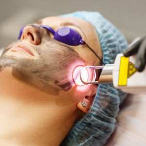 Phương pháp Laser Nhuộm