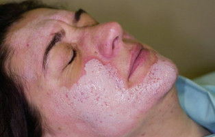So sánh các nhân tố Peeling trong Chemical Peel