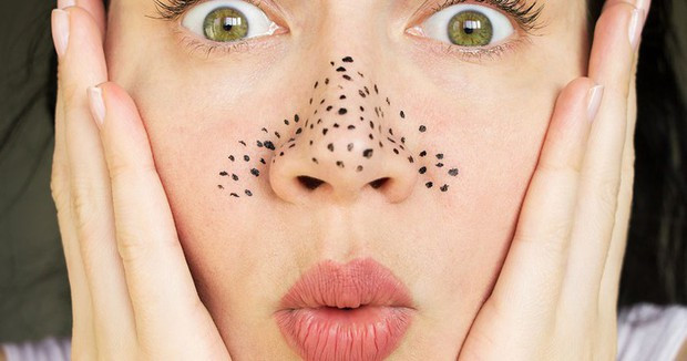 Sỏi bã nhờn: vấn đề phổ biến mùa hè