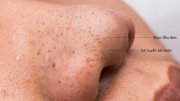 Sự khác biệt giữa sỏi bã nhờn và mụn đầu đen