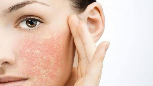 Tác dụng phụ của tretinoin