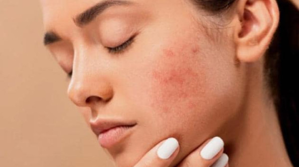 Tác dụng phụ khi peel da