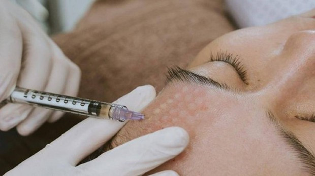 Tiêm meso là phương pháp làm đẹp phổ biến