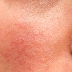 Tìm hiểu tác động của AHAs đối với da