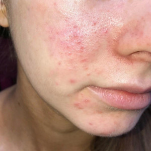 Vết thâm đỏ sau khi mụn đã vỡ