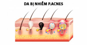Vi khuẩn P.Acnes – nguyên nhân chủ yếu gây mụn