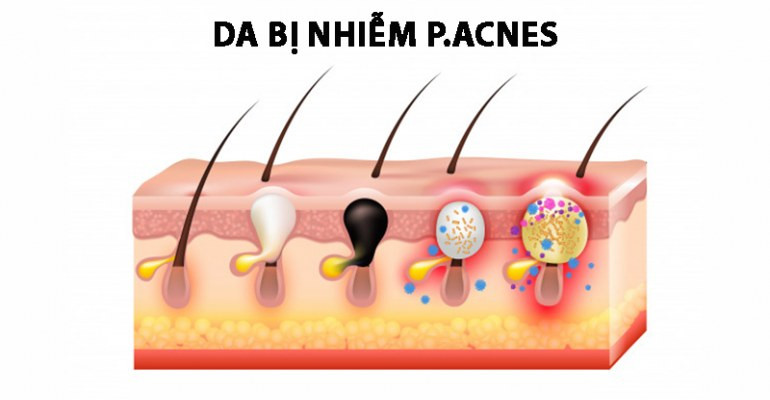 Vi khuẩn P.Acnes – nguyên nhân chủ yếu gây mụn