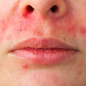 Viêm da quanh miệng là gì? Tình trạng da dễ bị nhầm lẫn với mụn