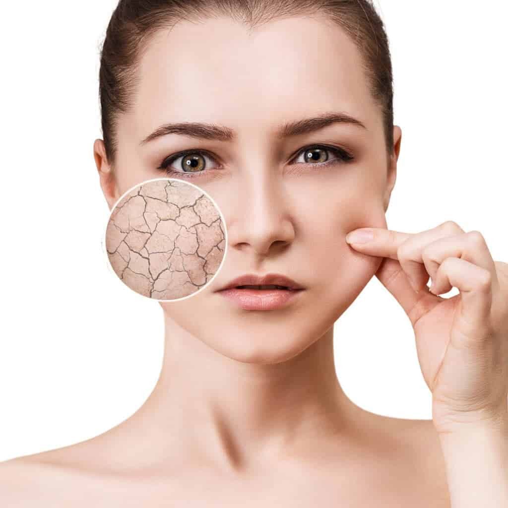 Da khô cần được chăm sóc cẩn thận