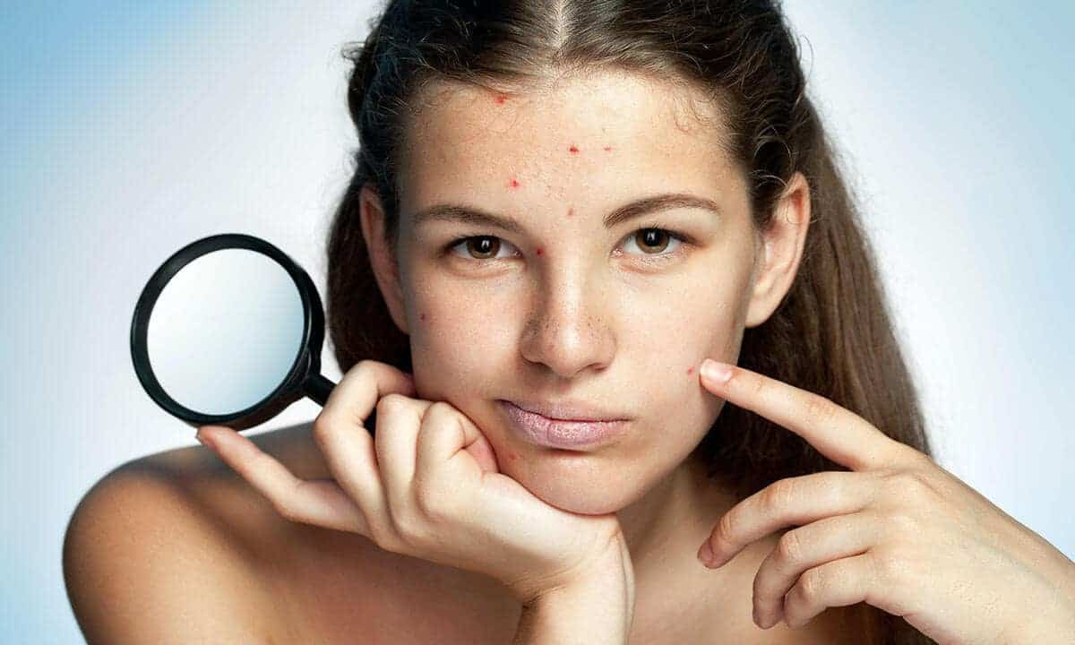 Đặc điểm làn da sau mụn