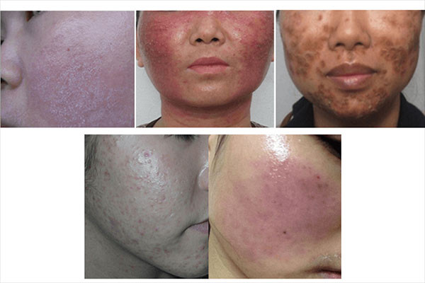 Dấu hiệu muộn