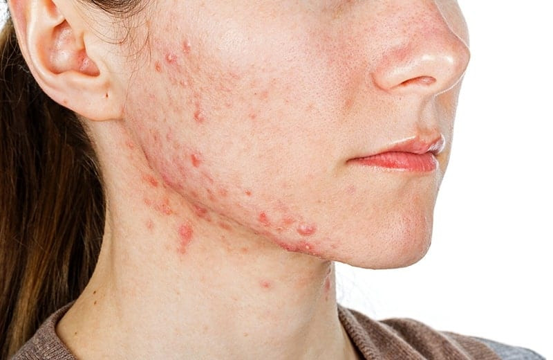 Dấu hiệu nhận biết da mặt bị dị ứng mỹ phẩm