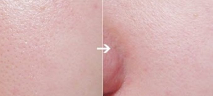 giải pháp se khít lỗ chân lông