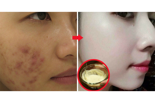 Làn da láng mịn mơ ước và những lời hoa mỹ về kem trộn