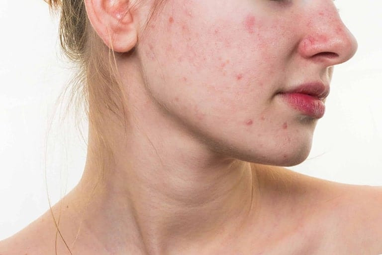 Loại bỏ tác nhân gây dị ứng