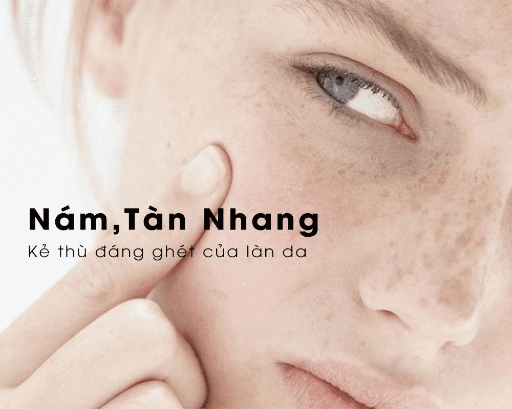 Lưu ý trong cách chăm sóc da bị nám