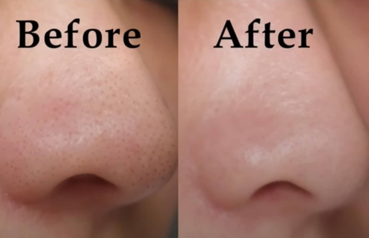 Mặt nạ lột mụn cho nam