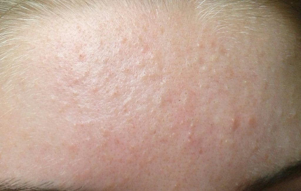 Mụn ẩn trên mặt
