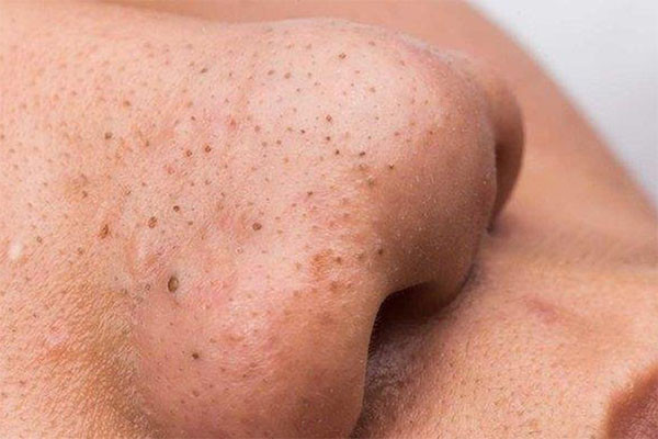 Mụn đầu đen trên mũi