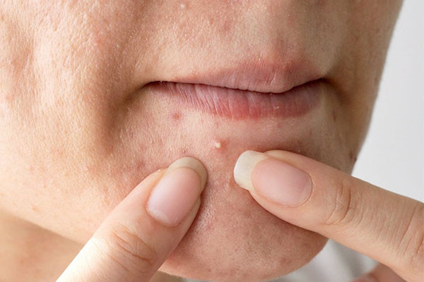Mụn đầu trắng xuất hiện gây mất thẩm mỹ