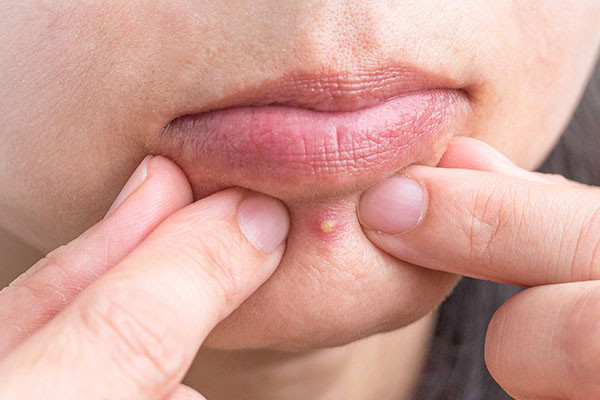 Mụn đầu trắng xuất hiện trên khuôn mặt