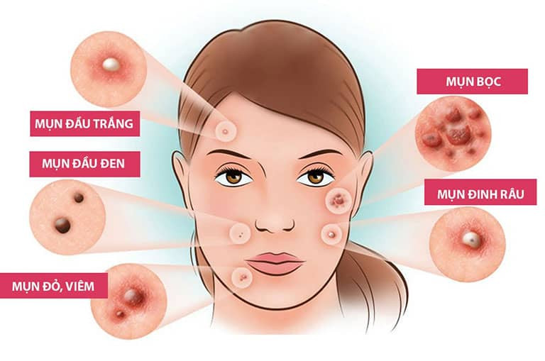 Mụn tuổi dậy thì