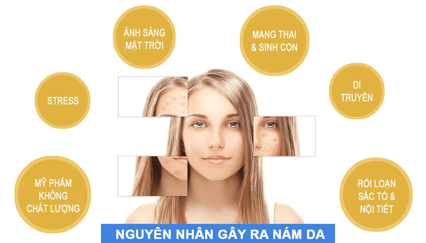 Nguyên nhân gây nám da