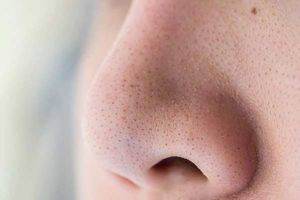 Những nốt mụn cám li ti trên mặt