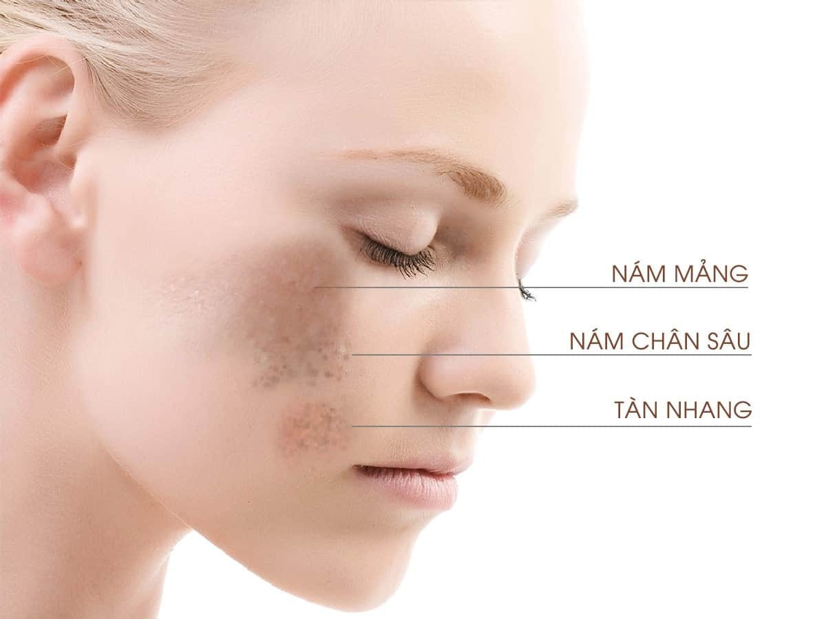 Phân biệt nám và tàn nhang