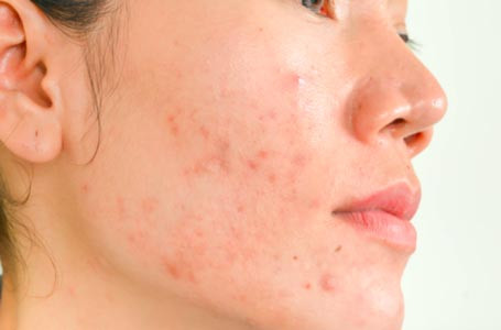 Purging da do sử dụng mỹ phẩm