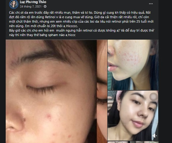 Retinol trong điều trị mụn