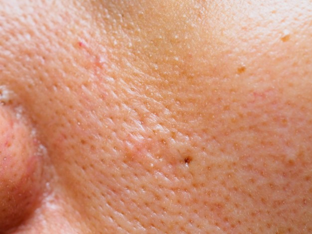 Tắc nghẽn lỗ chân lông