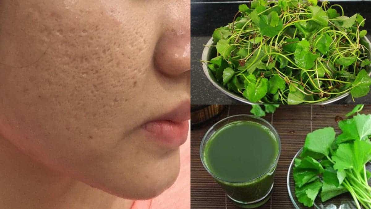 Trị Rỗ Bằng Rau Má