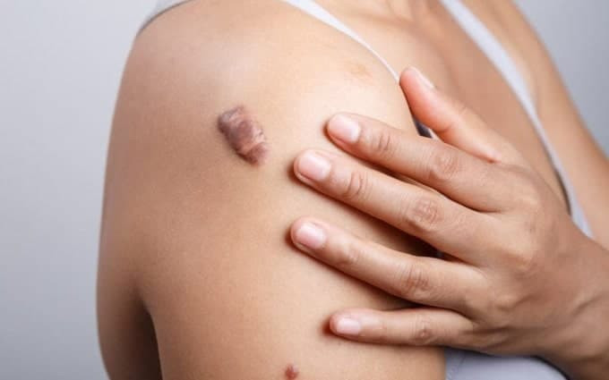 Trị sẹo lồi lâu năm bằng thiên nhiên