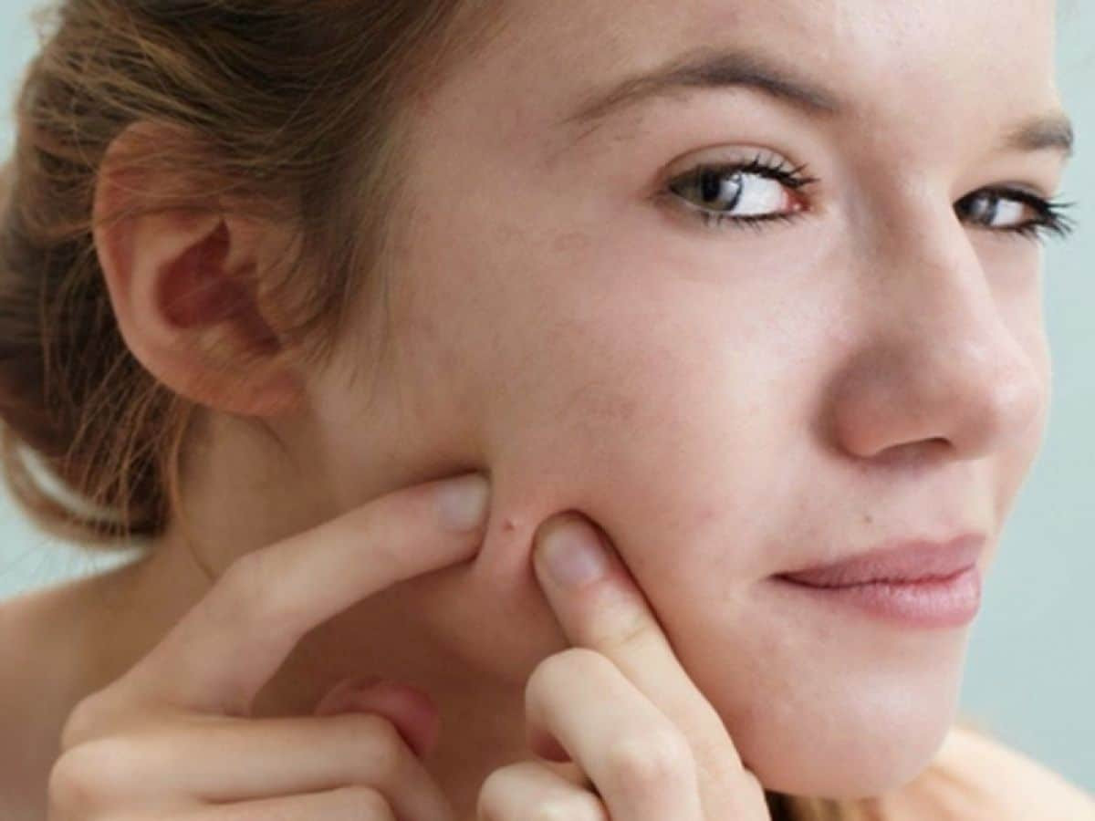 10 Điều Cần Tránh Khi Bị Mụn Để Bảo Vệ Làn Da Khỏe Mạnh