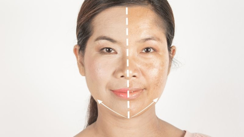 12 Cách Chữa Nám Da Sau Sinh Cho Phụ Nữ An Toàn và Hiệu Quả