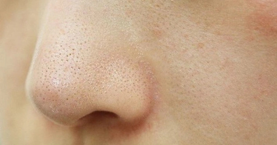 13 Cách Làm Sạch Sỏi Bã Nhờn Ở Mũi Hiệu Quả