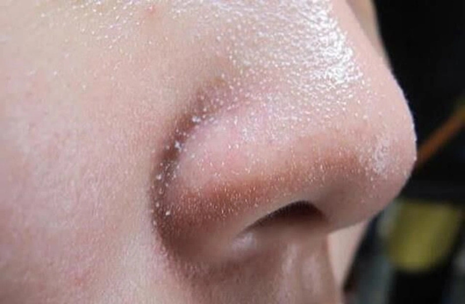 13 Cách Làm Sạch Sỏi Bã Nhờn Ở Mũi Hiệu Quả