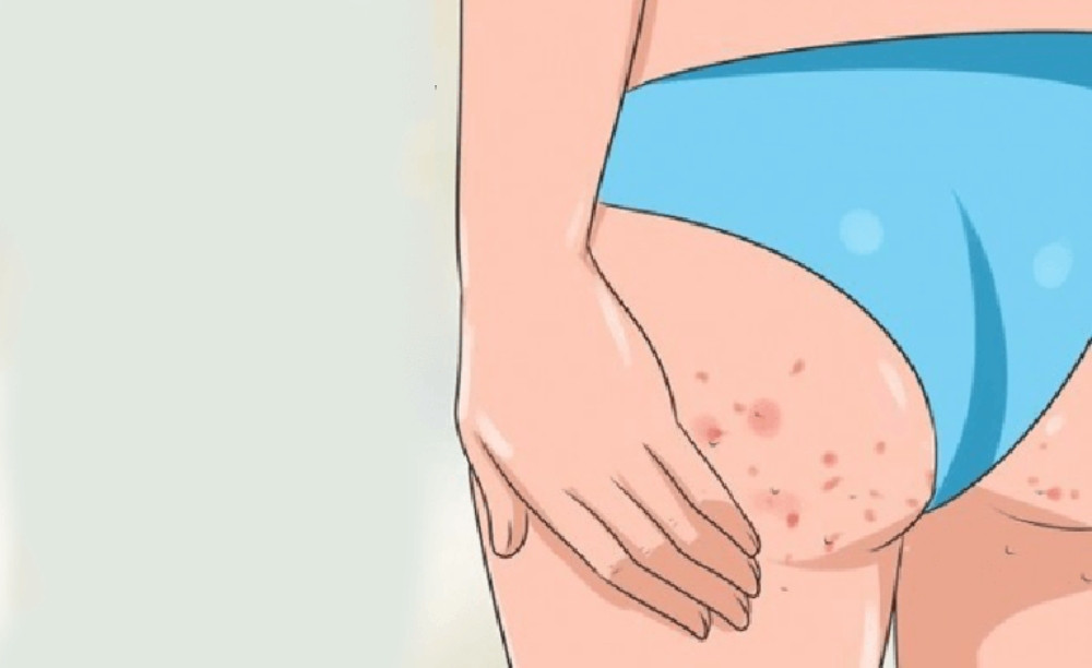 15 Cách Chăm Sóc Da Vùng Mông Trắng, Mịn Hiệu Quả